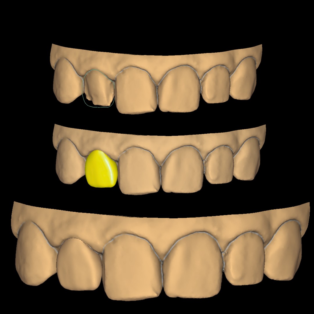 COROA ESPELHADA