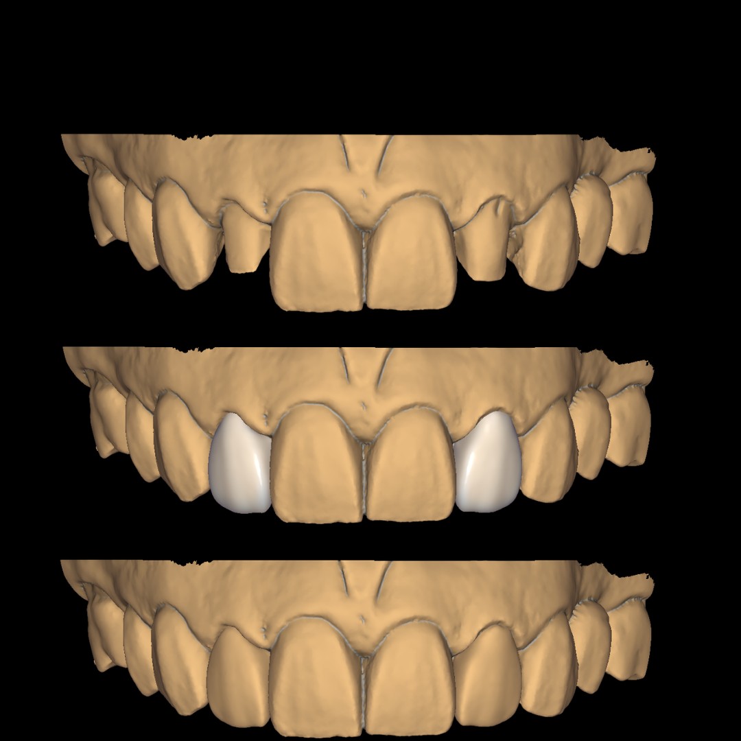 COROAS SOBRE DENTE