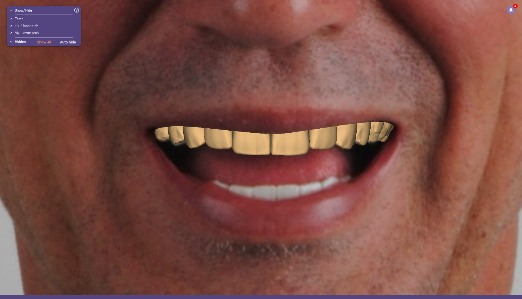 PLANEJAMENTO DIGITAL/SMILE DESIGN WAXUP