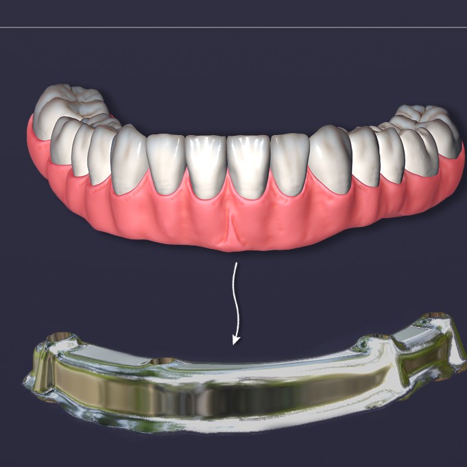 Protocolo dentogengival + i-bar
