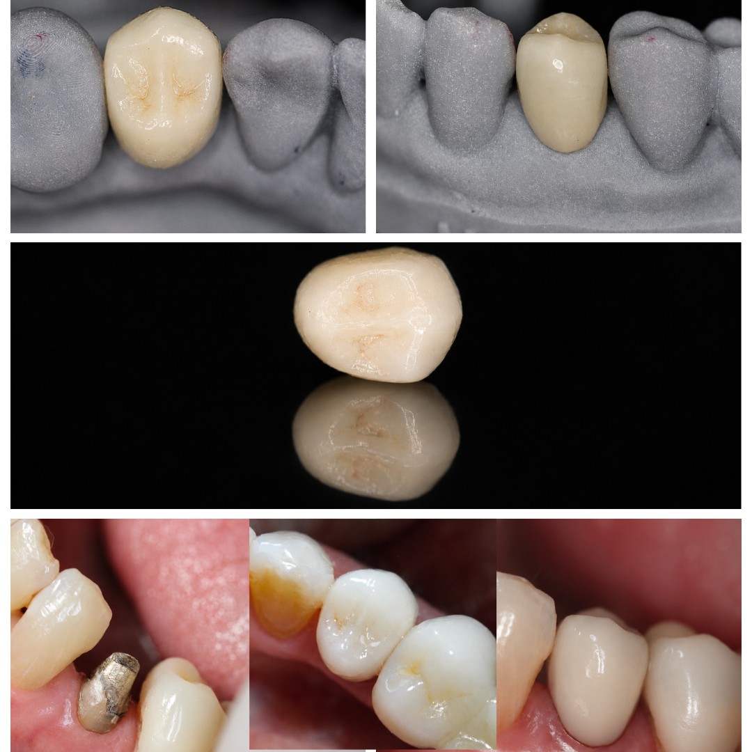 caso 1 dente 34