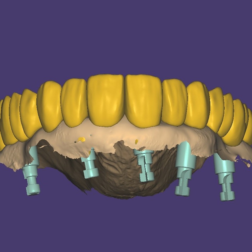Protocolo Sem Gengiva